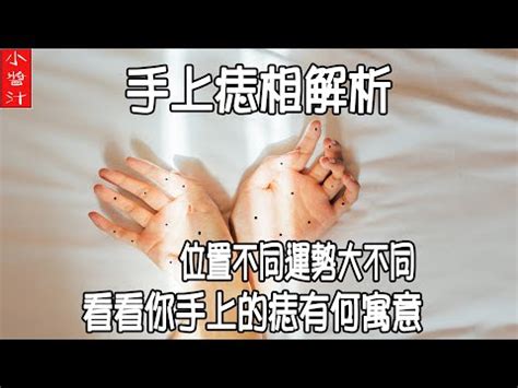 女右手掌突然長痣|右手掌長痣，婚姻運勢如何？